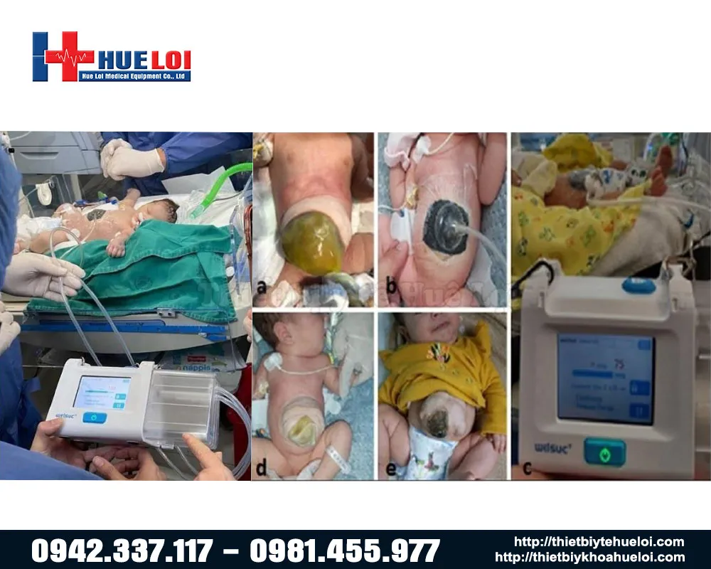 Điều trị vết thương hở bằng máy rh 1000