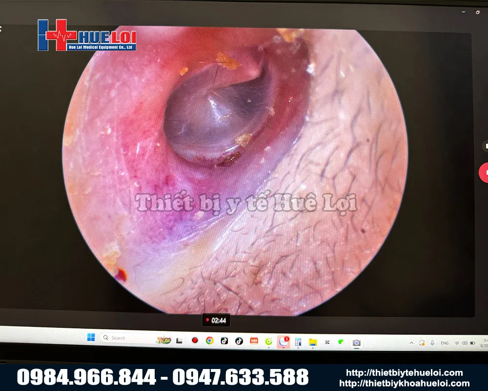 Máy nội soi tai mũi họng di động 