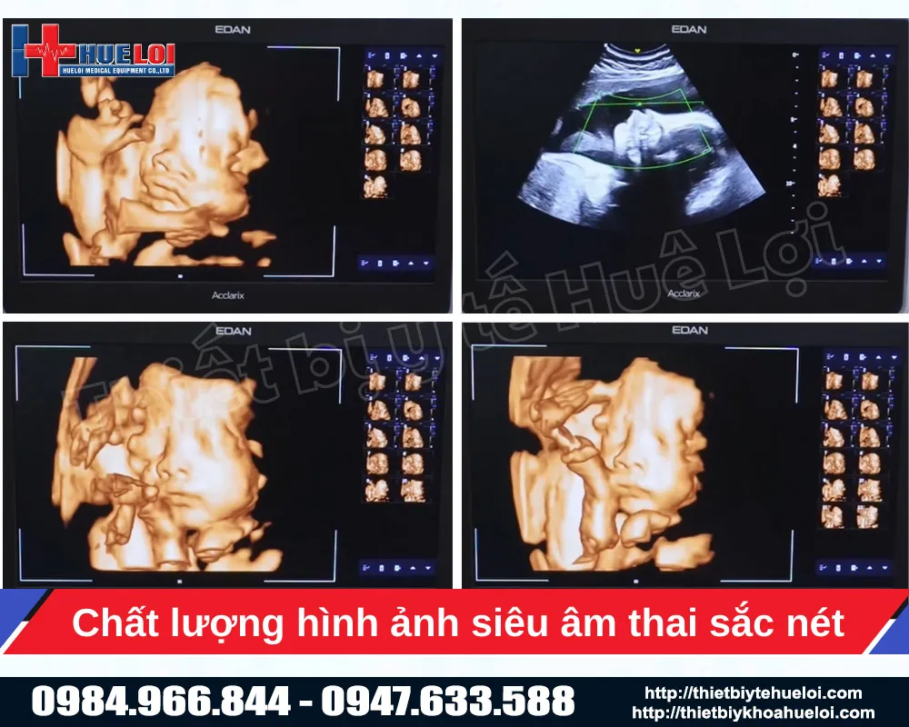 Máy siêu âm 5D ở thai nhi của máy siêu âm edan lx85