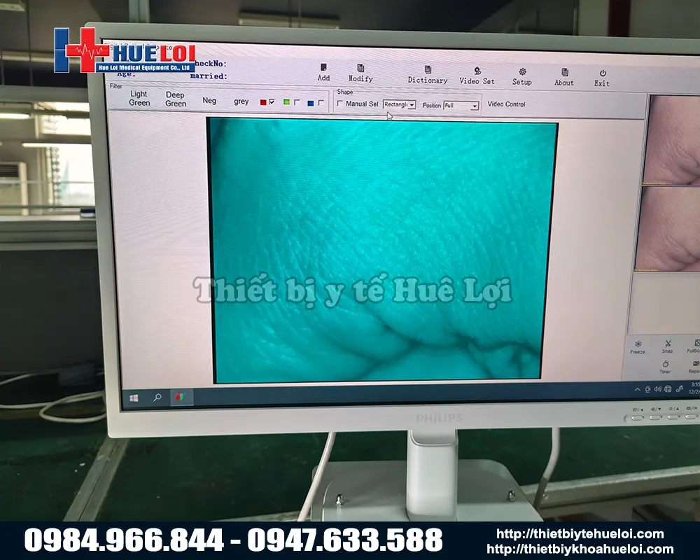 Chất lượng hình ảnh máy soi cổ tử cung sanwe giá rẻ