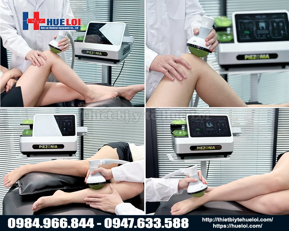 M&aacute;y s&oacute;ng xung k&iacute;ch hội tụ &aacute;p điện hu&ecirc; lợi