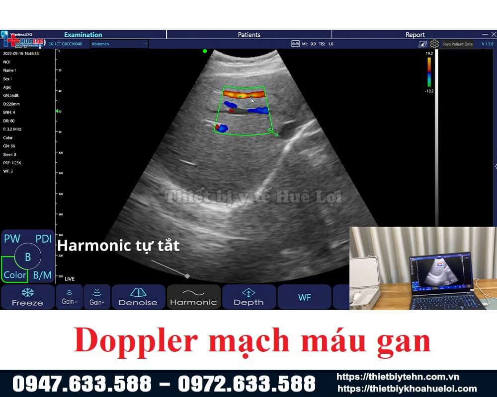 doppler mạch máu gan