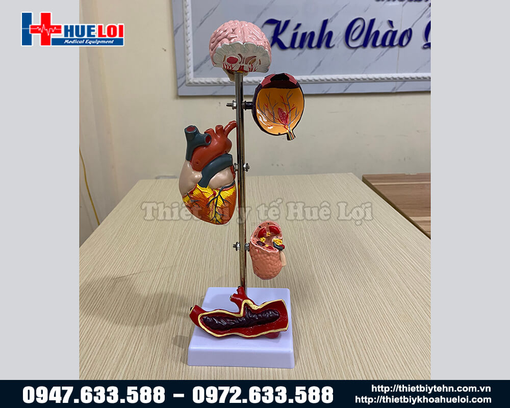 Mô hình biến chứng bệnh lý tăng huyết áp